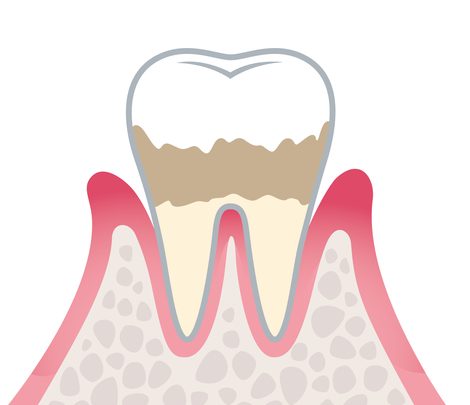 軽度歯周病（歯肉炎・歯周炎）