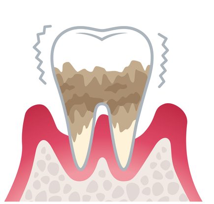 重度歯周病（歯周炎）